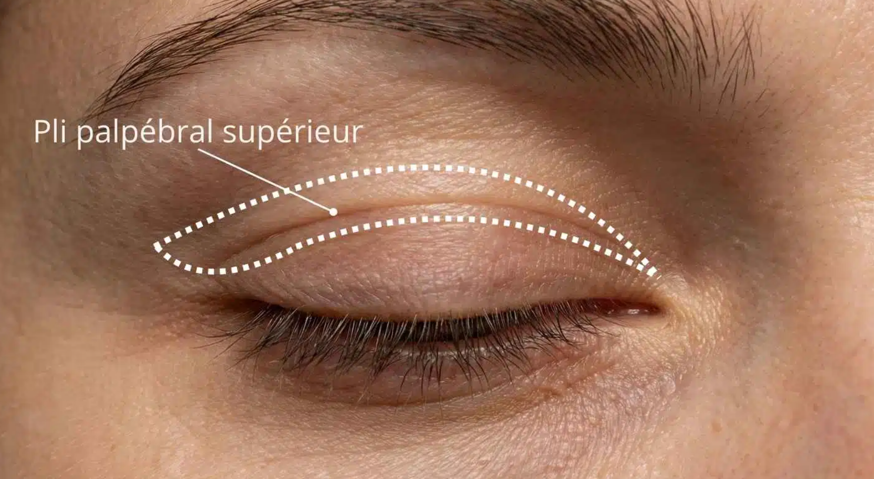 Blépharoplastie