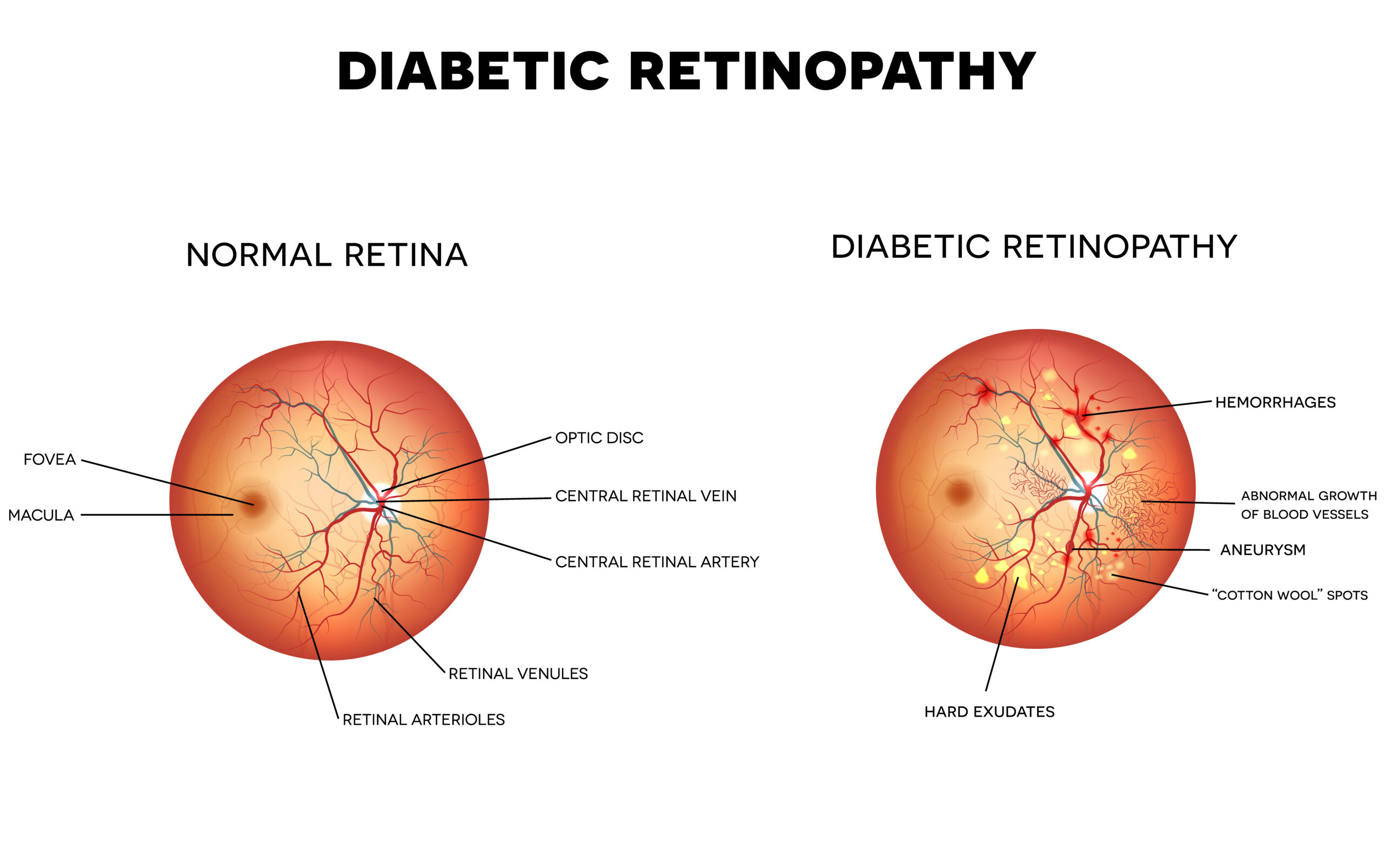 Rétinopathie diabétique