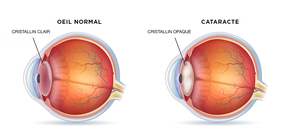 Chirurgie de la Cataracte