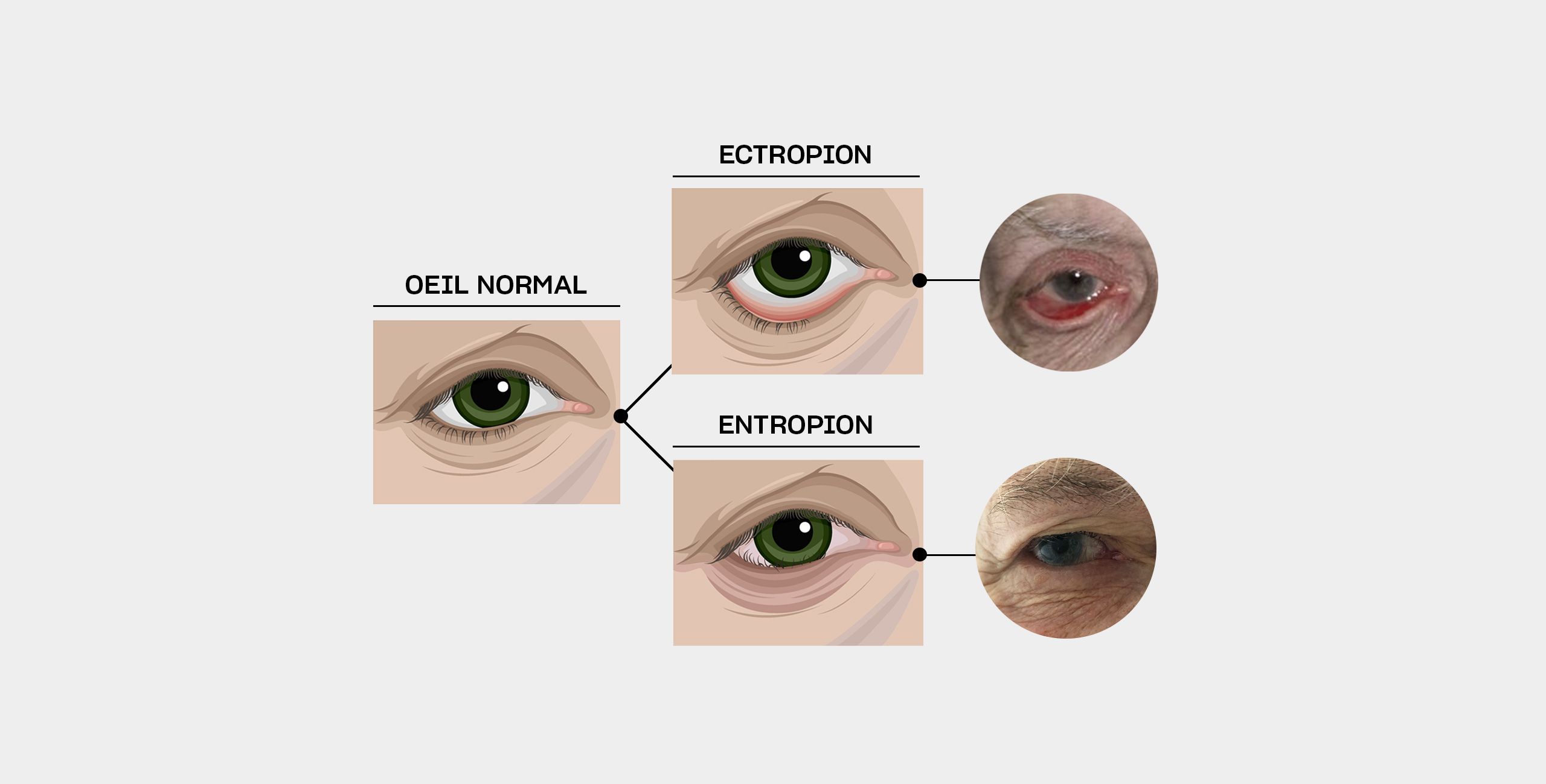 Ectropion et Entropion