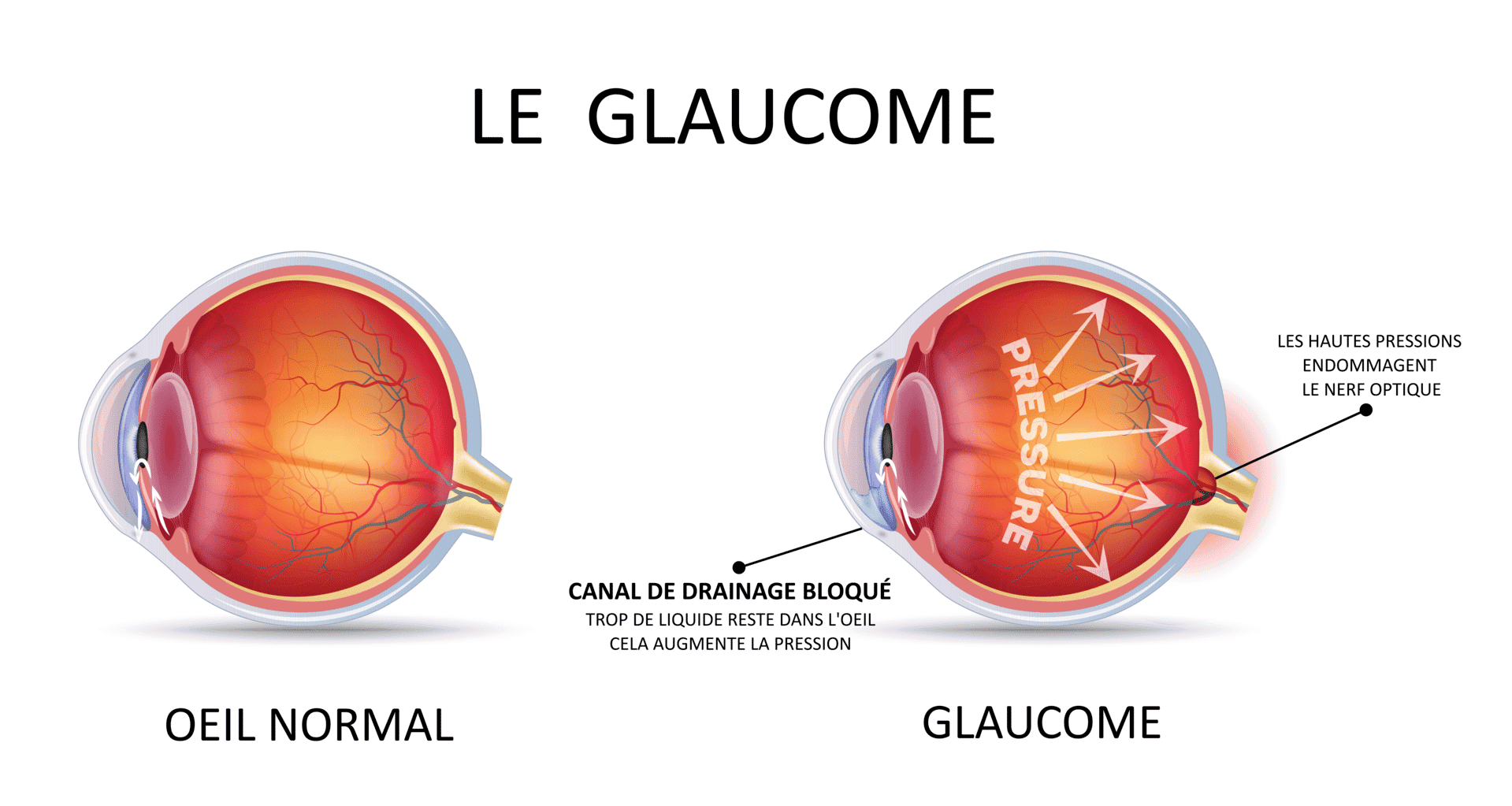 Traitement du glaucome