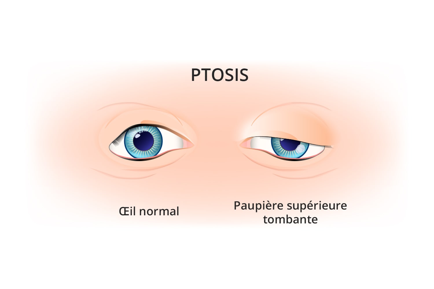 Ptosis